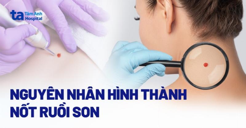 Nốt ruồi son chảy máu