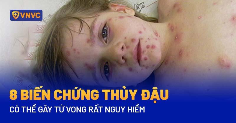 Biến Chứng Thủy Đậu Ở Người Lớn: Nguy Hiểm Khôn Lường