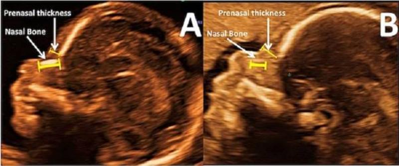 Chiều Dài Xương Mũi Thai Nhi Tuần 12