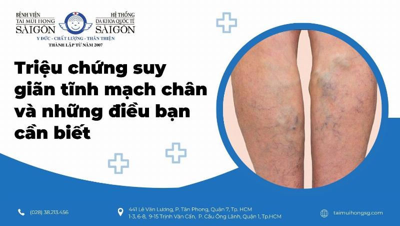 Dấu hiệu nhận biết giãn tĩnh mạch