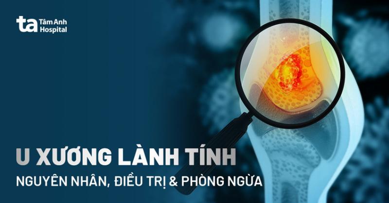 Đau nhức âm ỉ: Dấu hiệu u xương lành tính