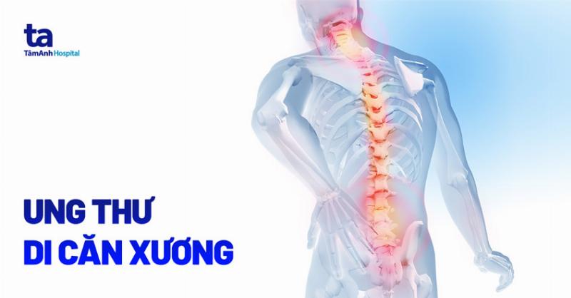 Nhận Biết Dấu Hiệu Ung Thư Di Căn Xương