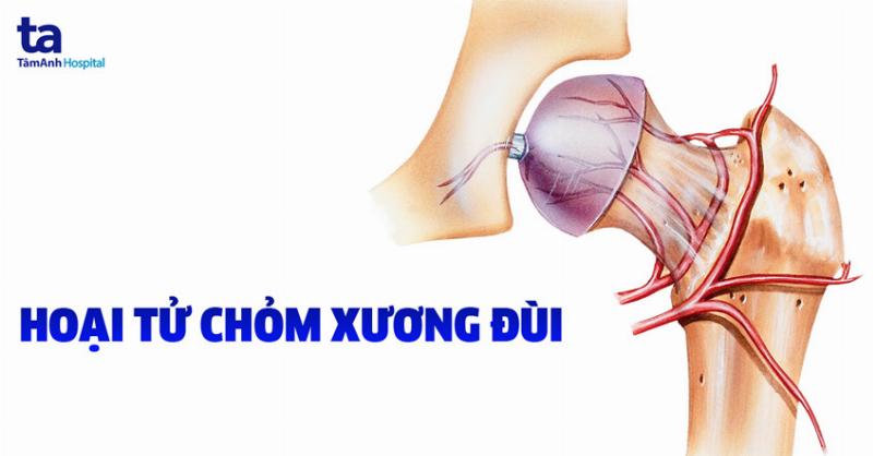 Nguyên Nhân Hoại Tử Chỏm Xương Đùi