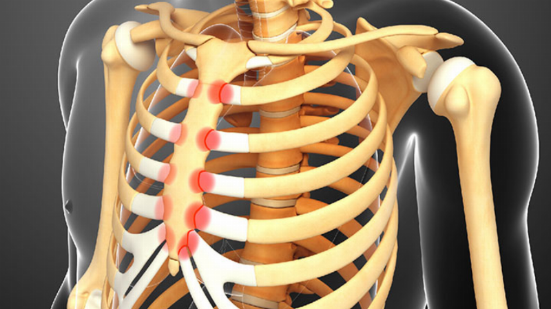 Mũi Xương Ức Nhô Cao: Triệu Chứng Nhận Biết