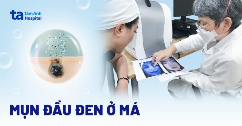 Nguyên nhân gây mụn đầu đen ở má