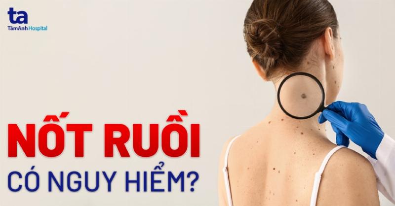 Nốt ruồi tự nhiên xuất hiện trên da