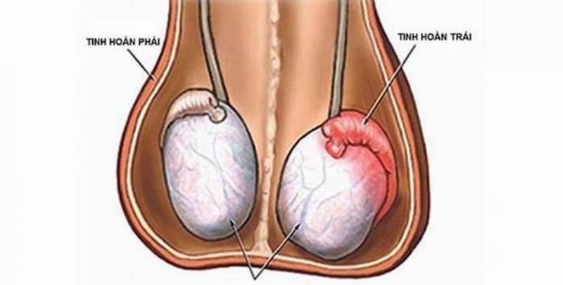 Chăm Sóc Sức Khỏe Tinh Hoàn