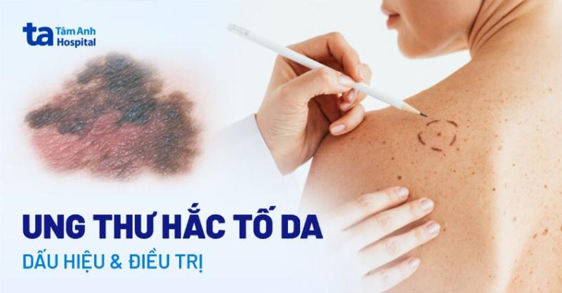 Ung Thư Tế Bào Hắc Tố: Hiểu Rõ Để Phòng Tránh