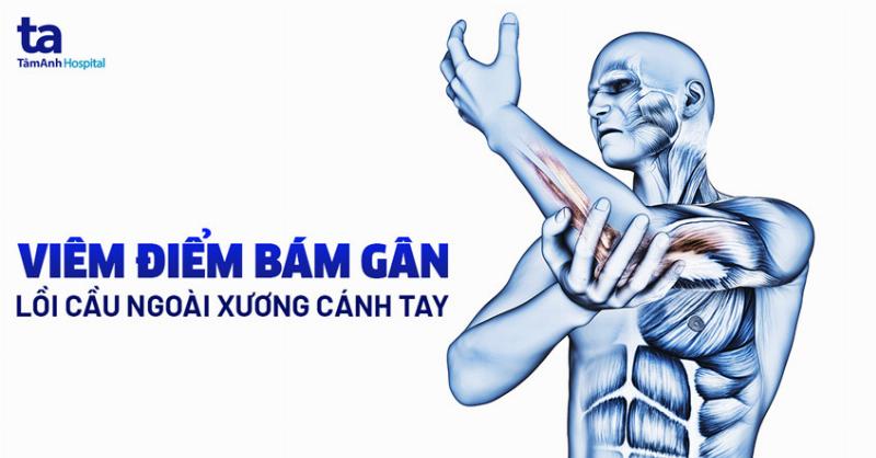 Triệu chứng viêm điểm bám gân lồi cầu ngoài xương cánh tay