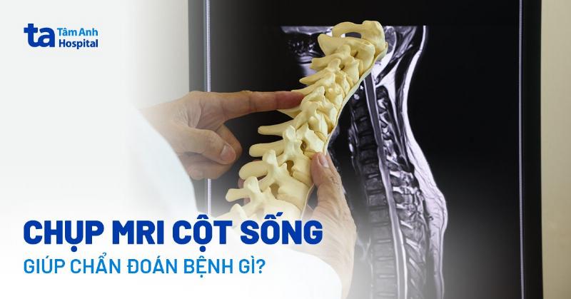 Hình ảnh MRI Cột Sống: Đánh Giá Chi Tiết Tình Trạng Đĩa Đệm và Dây Chằng