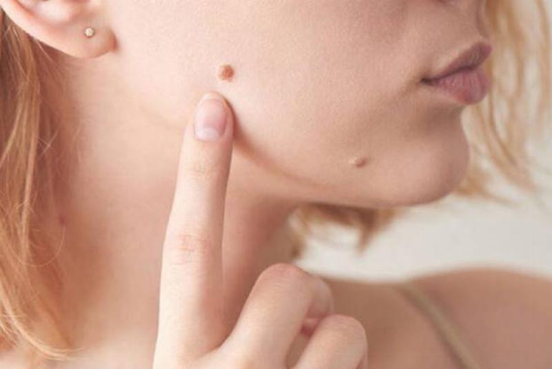 Chăm sóc nốt ruồi ở thái dương: Bảo vệ và Theo dõi