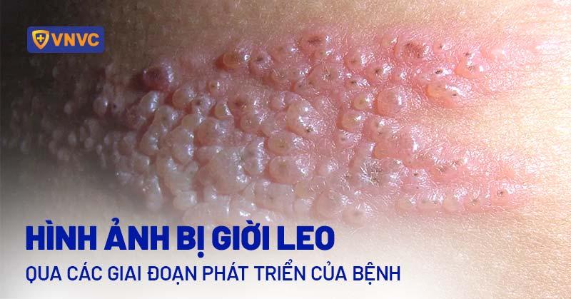 Hình ảnh zona sắp khỏi giai đoạn đóng vảy
