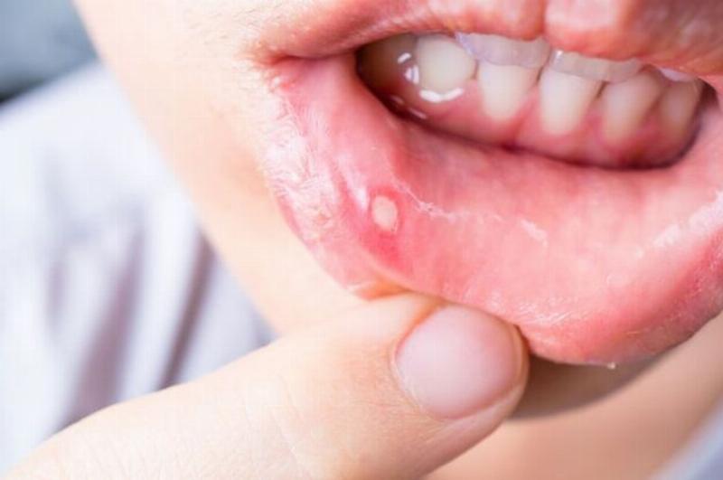 Nhiệt Miệng Thiếu Vitamin Gì? Nguyên Nhân, Triệu Chứng và Cách Điều Trị Hiệu Quả