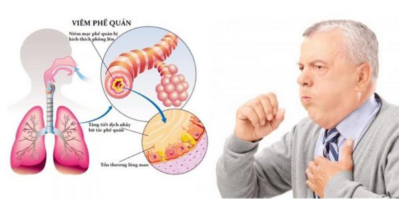 Các Bệnh Đường Hô Hấp Thường Gặp, Triệu Chứng, Nguyên Nhân và Cách Điều Trị